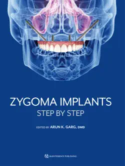 zygoma implants book cover image