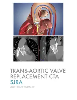 trans-aortic valve replacement cta book cover image